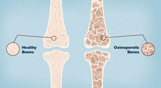 Osteoporosis