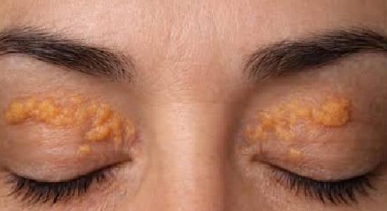 Persona con xantelasma