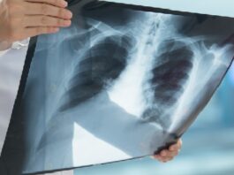 Menos del 5 % de nódulos pulmonares resultan cancerosos